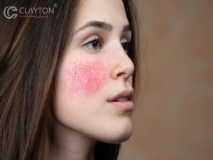 قبل و بعد از استفاده از کرم ضد قرمزی