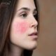 قبل و بعد از استفاده از کرم ضد قرمزی